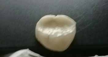 被奶糖粘下来的烤瓷牙