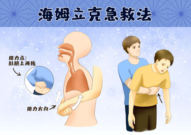 海姆立克急救法